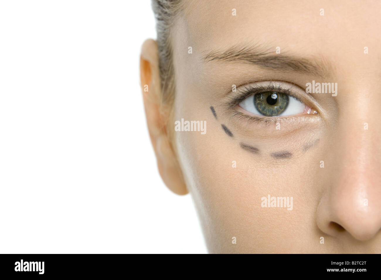 Junge Frau mit plastischen Chirurgie Markierungen unter Auge, beschnitten Ansicht Stockfoto