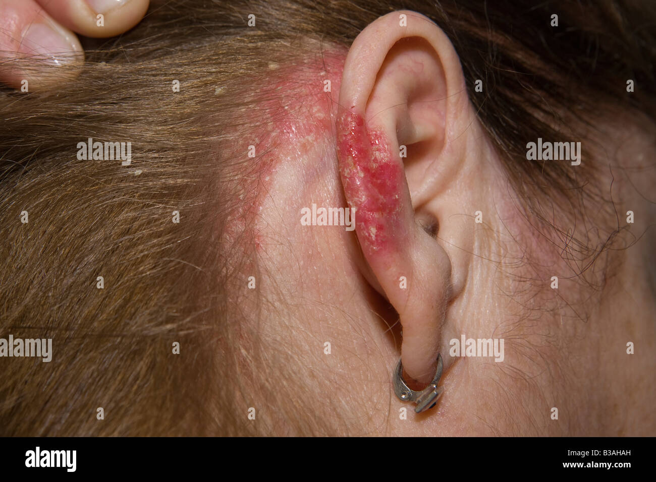 Psoriasis an Ohr und Kopfhaut in eine Frau von 60 Jahre alt Stockfotografie  - Alamy