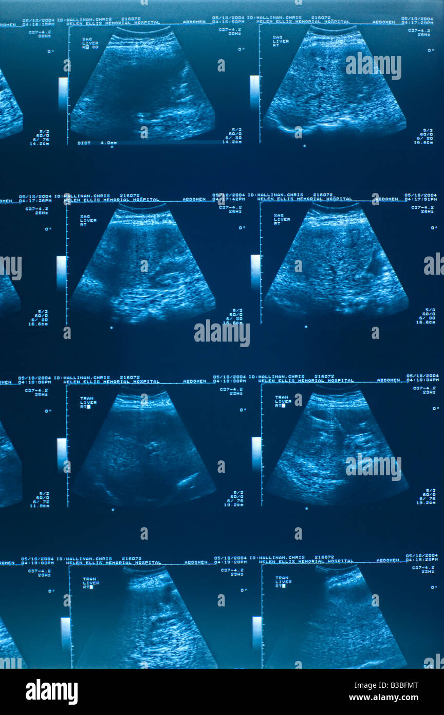 Ultraschall der weiblichen Brust Stockfoto