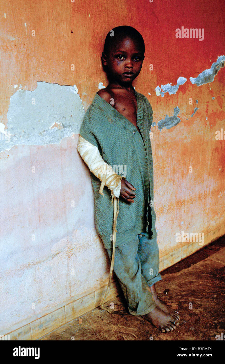BURUNDIS ETHNISCHE KONFLIKTE ", NOVEMBER 1993.  KERIMBA KRANKENHAUS, BUWERU PROVINZ. VERLETZTE KIND Stockfoto