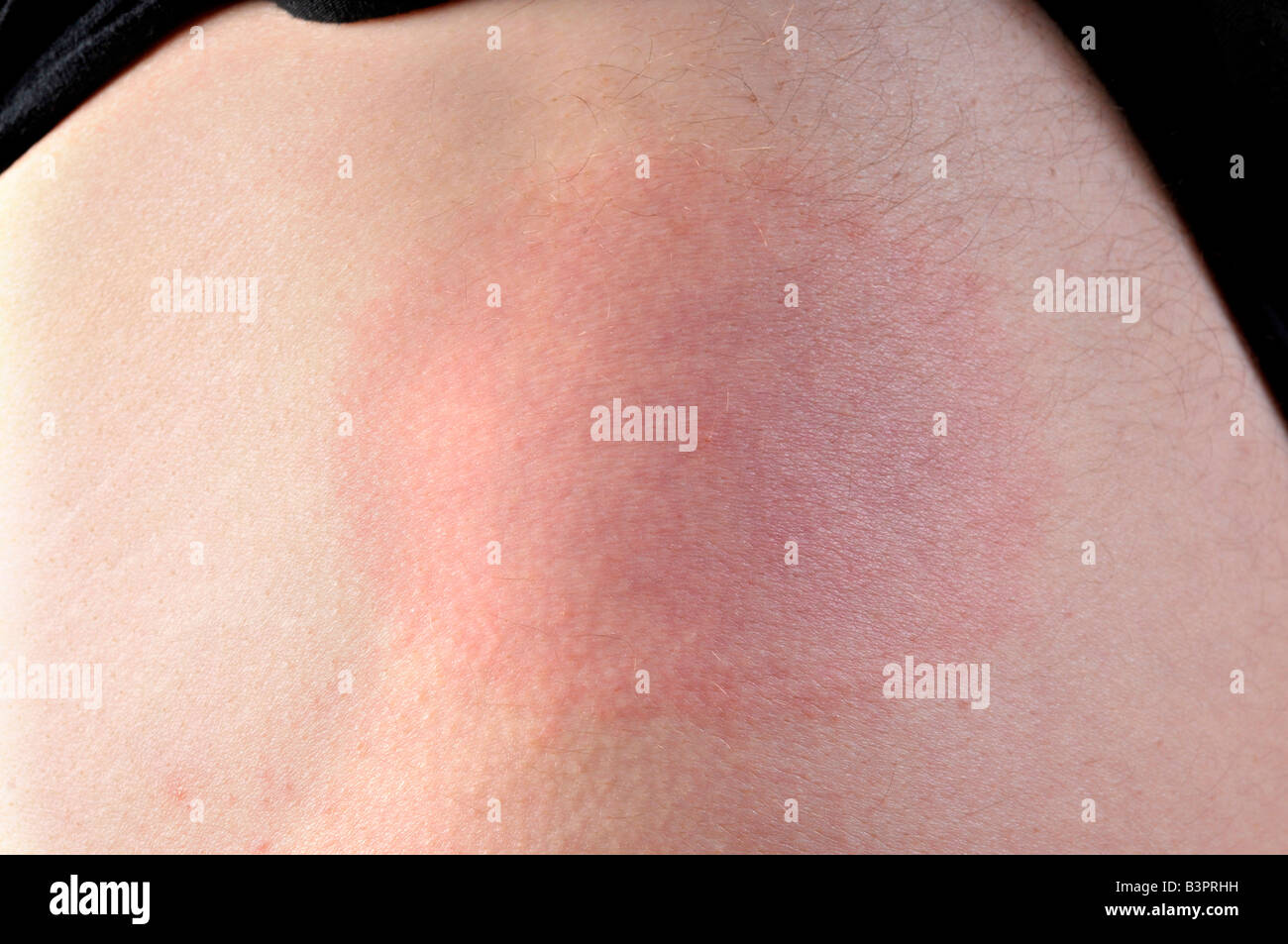 Zeckenbiss Stockfotos &amp; Zeckenbiss Bilder Alamy