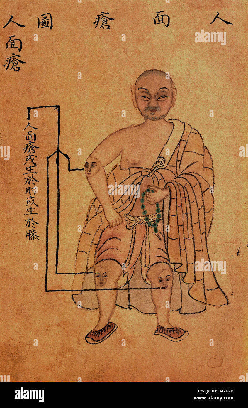 Medizin, Huichun, chinesische Medizin, Symptome, Abbildung von Abszessen mit menschlichem Gesicht, 1742, Stockfoto