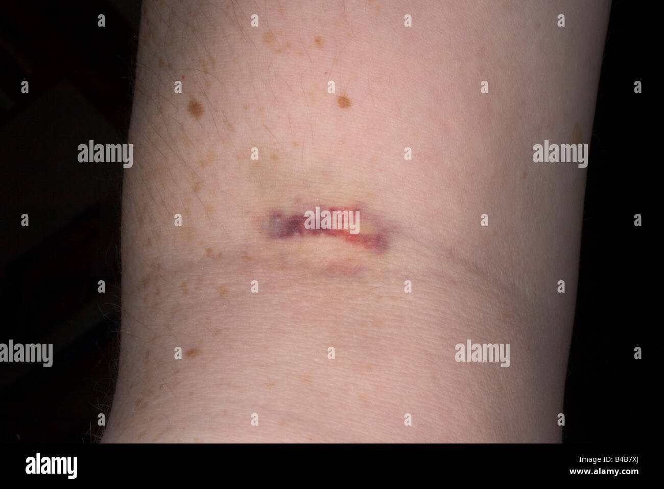 Links nach einer Blutprobe Ring Flash-Prellung Stockfoto