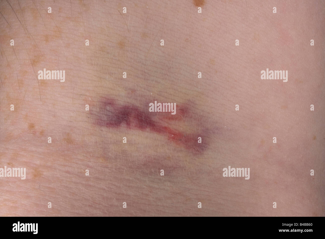 Links nach einer Blutprobe Ring Flash-Prellung Stockfoto