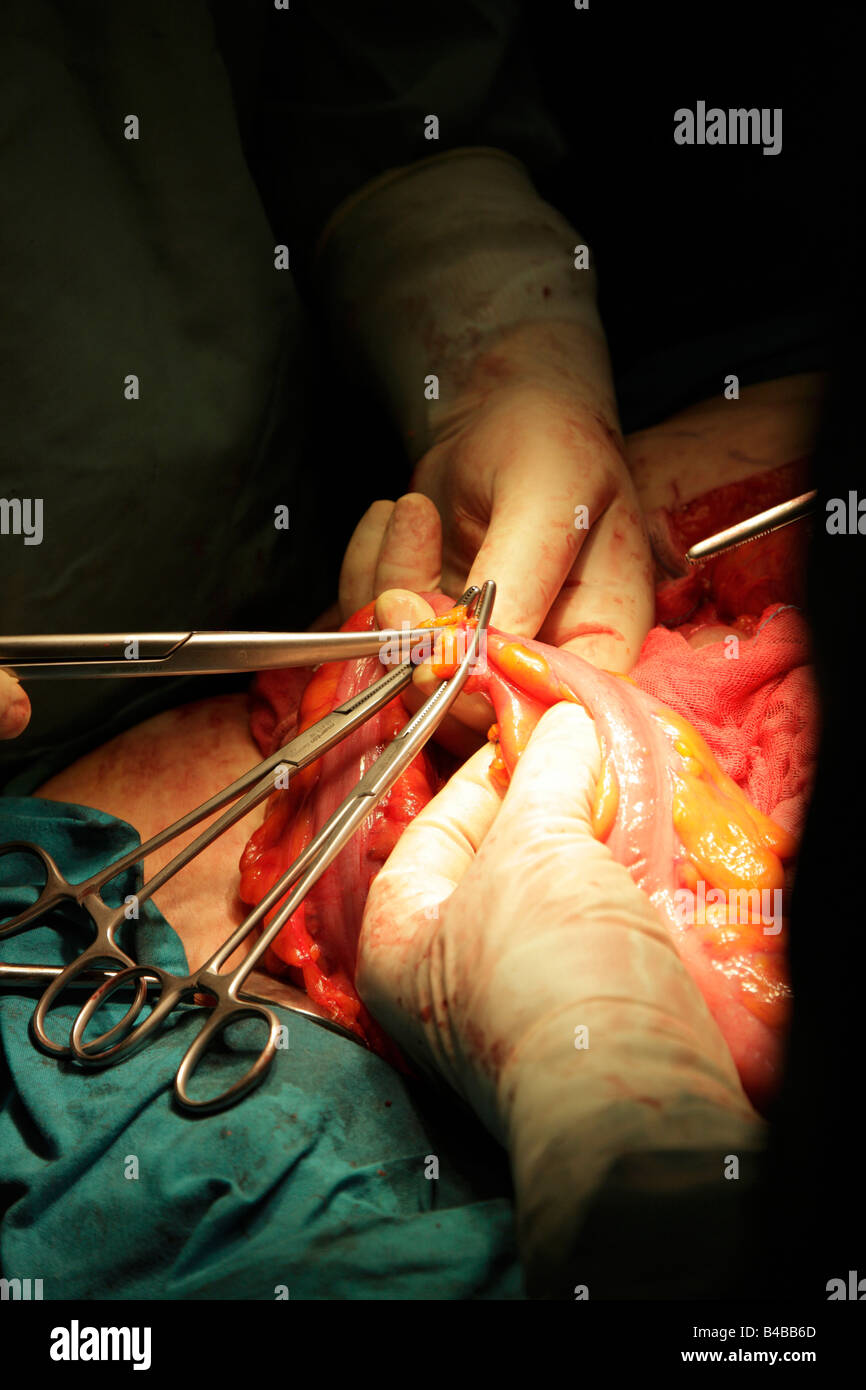 Chirurgen clipping Doppelpunkt mit Kelly chirurgischen Instrument krebsartigen Abschnitt und Restitch entfernen Stockfoto