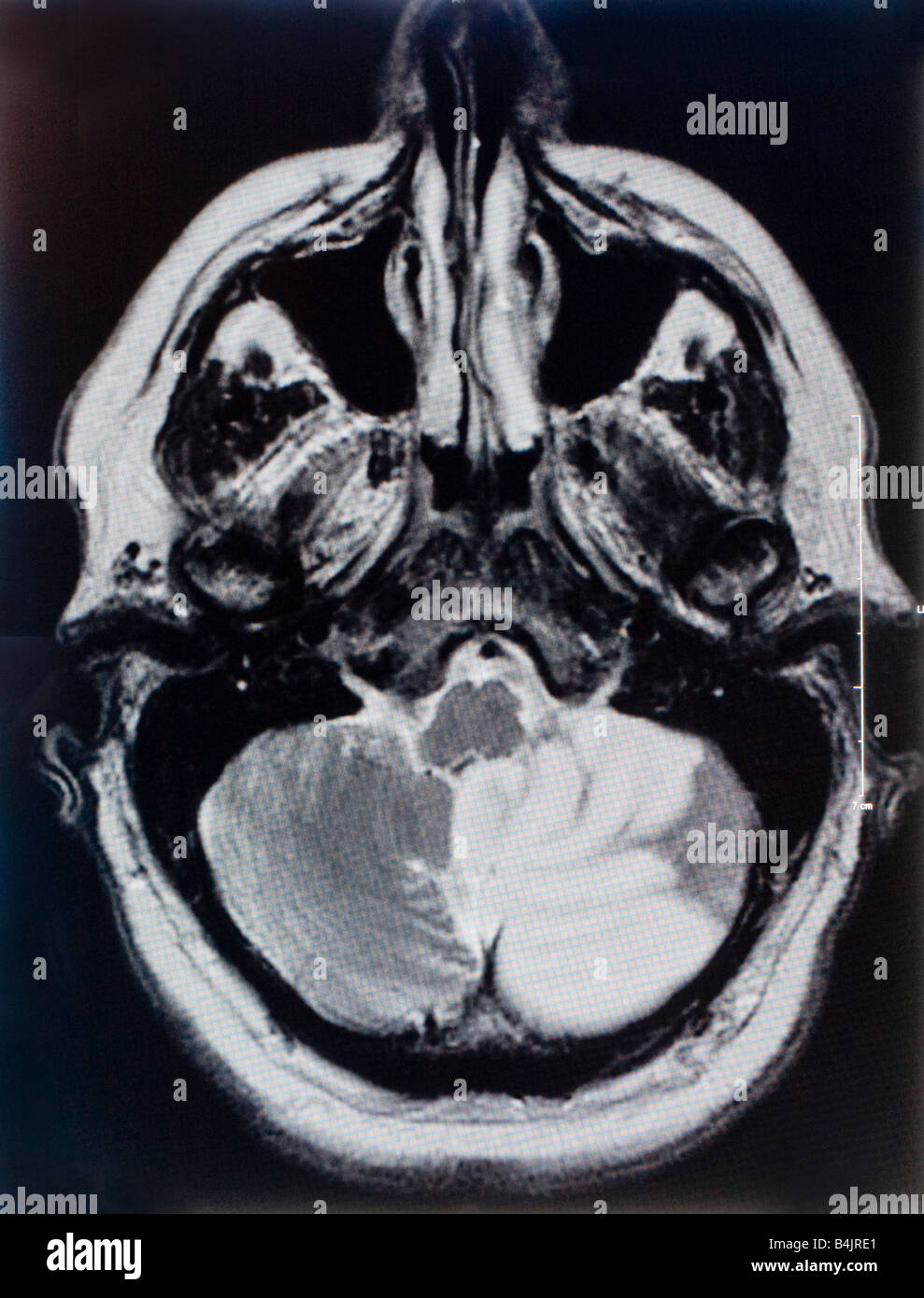 Tomographische Gehirn-Scan eines 60 Jahre alten männlichen Schlaganfall Opfer Hinweis leicht farbigen Bereich am unteren Stockfoto