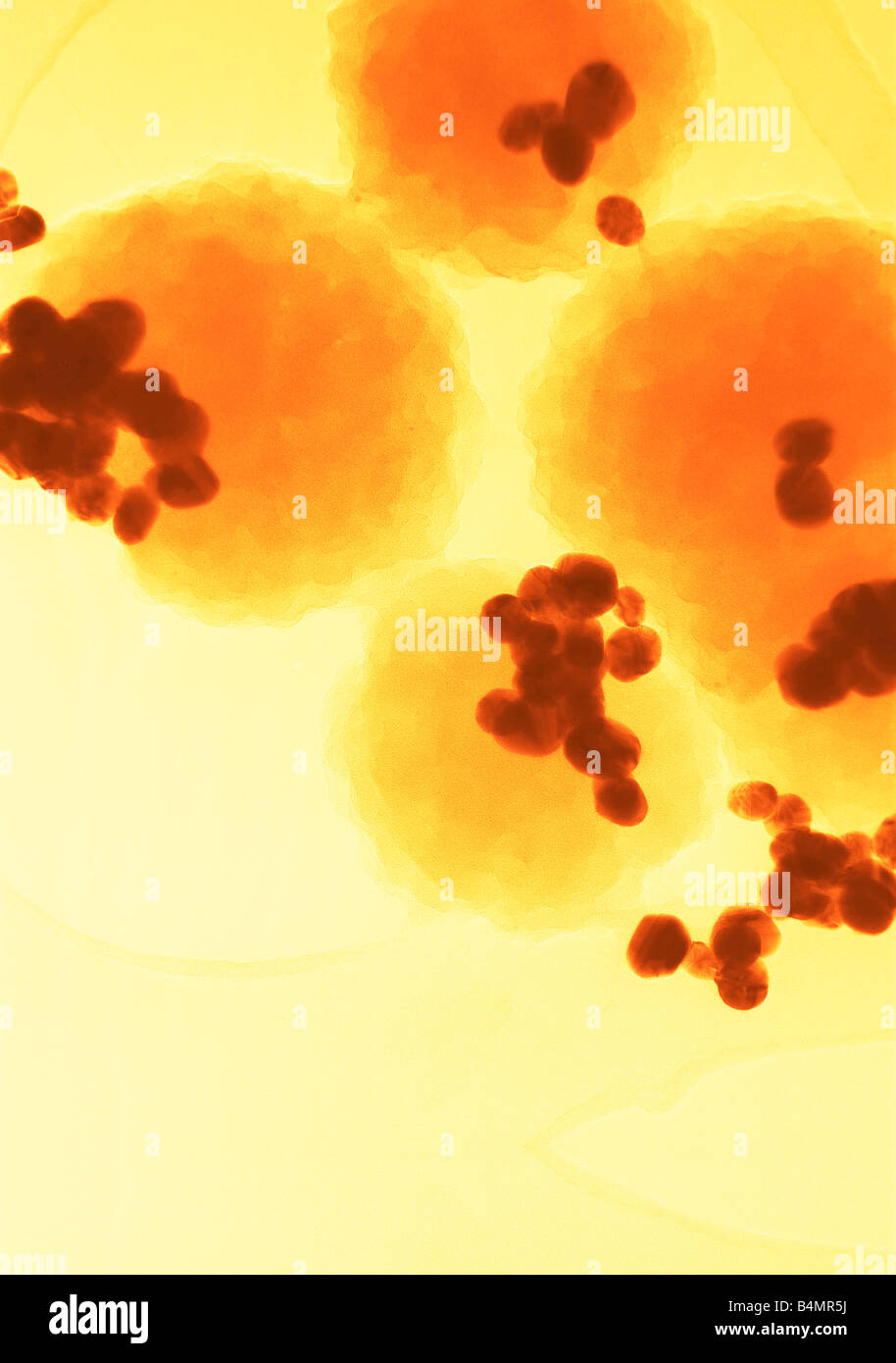 Falschfarbenbild von Krebszellen mit normalen menschlichen Zellen vor der Behandlung verbunden. Medizinische Anwendungen von nanotechnologischen Stockfoto