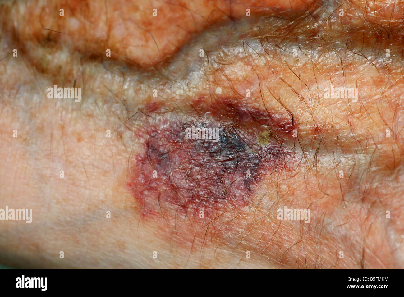Hautverdünnung und Blutergüsse auf einen alten Mann hand Stockfoto