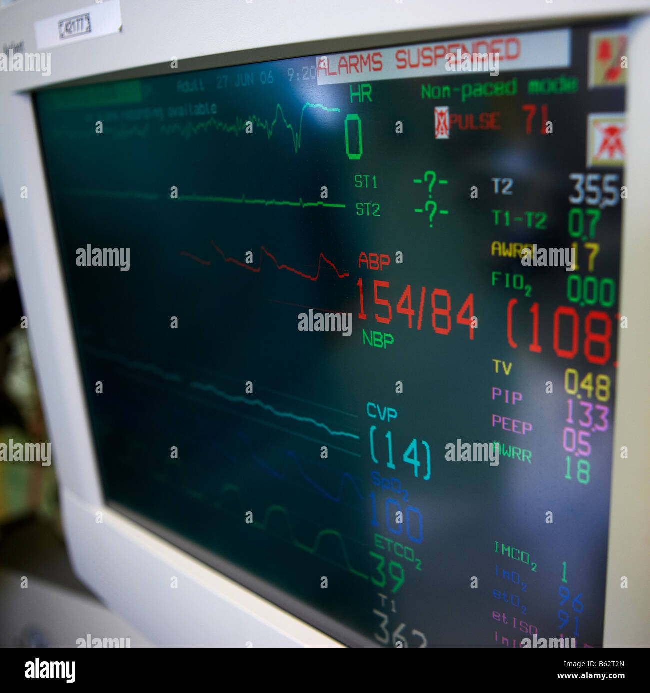 Computer-Monitor mit Herz bei Bypass-Operation, Reykjavik Island Stockfoto