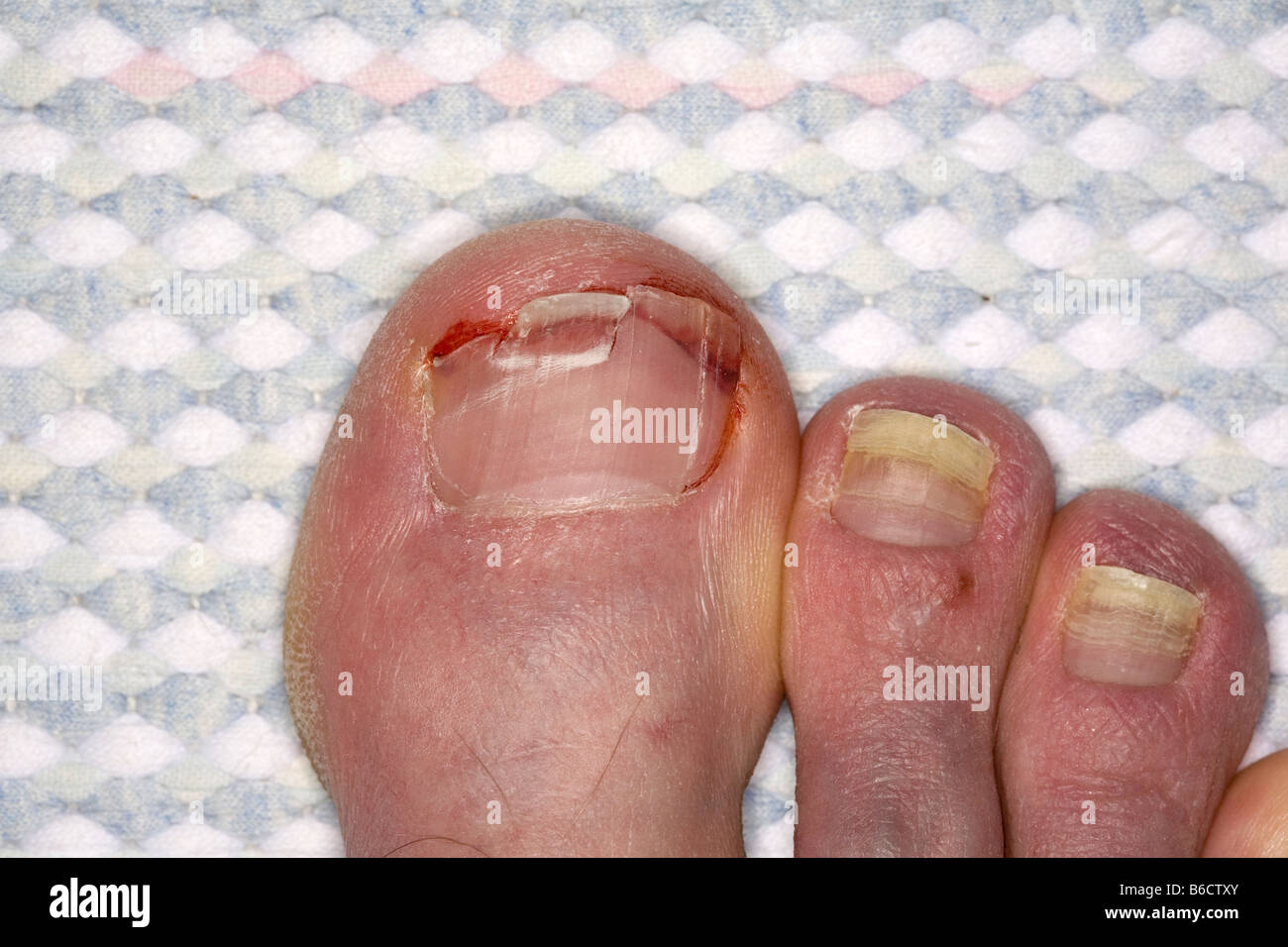 gebrochene Zehennagel Stockfoto