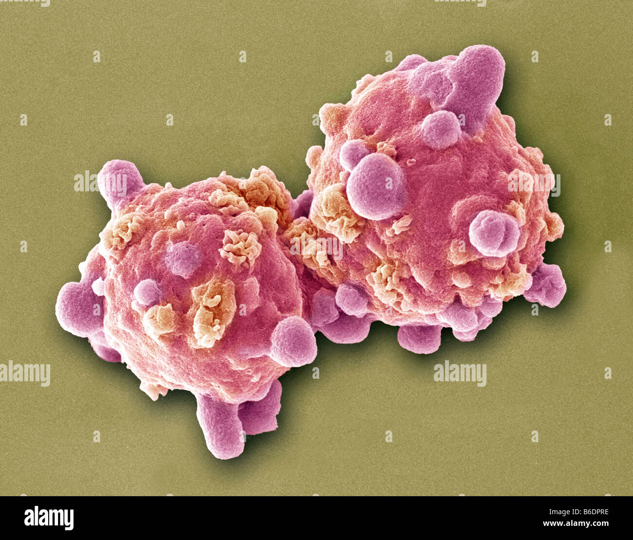 Leukämie weißen Blutkörperchen, farbige Scanningelectron Schliffbild (SEM) Stockfoto