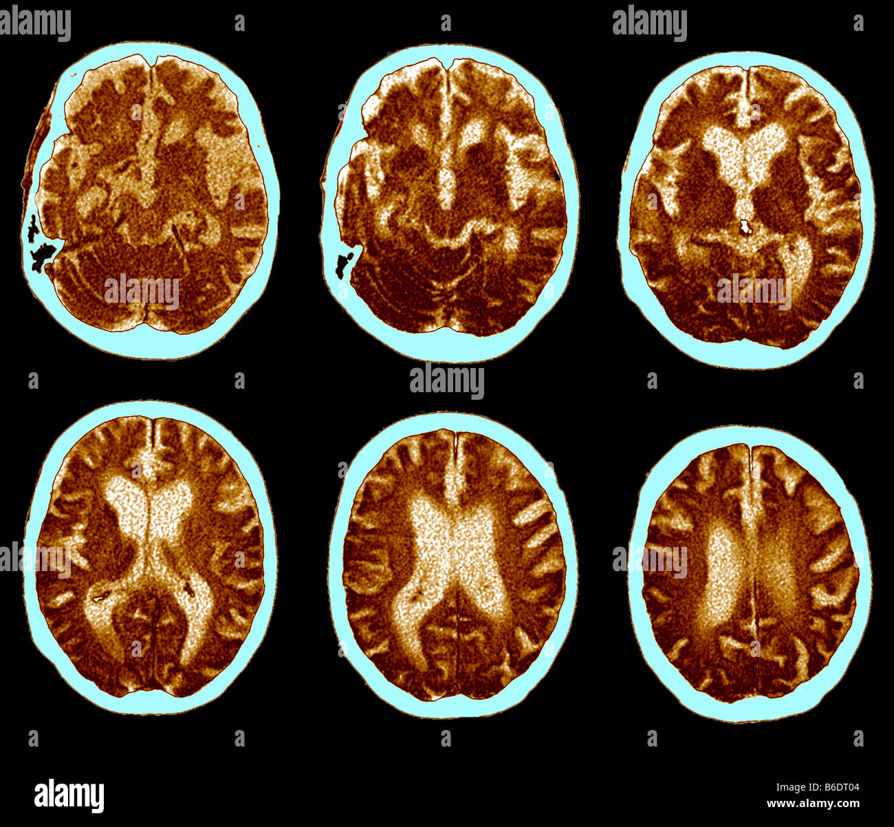 Alzheimer-Krankheit. Serie von Computertomographie (CT) Scans einer axialen Abschnitt durch den ...