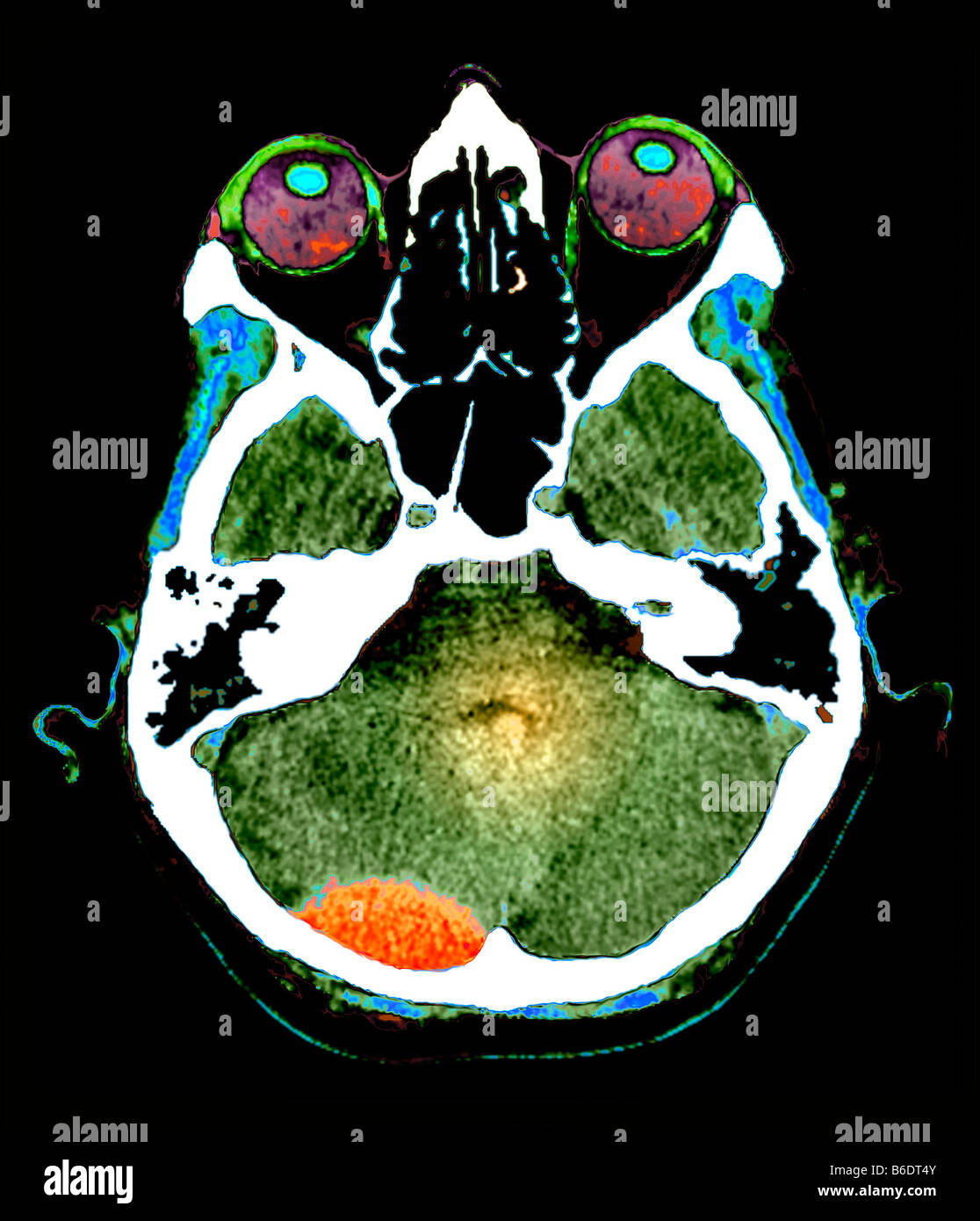 Extradural haematoma.andlt;/strongandgt; Farbige berechnet Computer-Tomographie(CT) Scan eines Abschnitts durch den Schädel Stockfoto