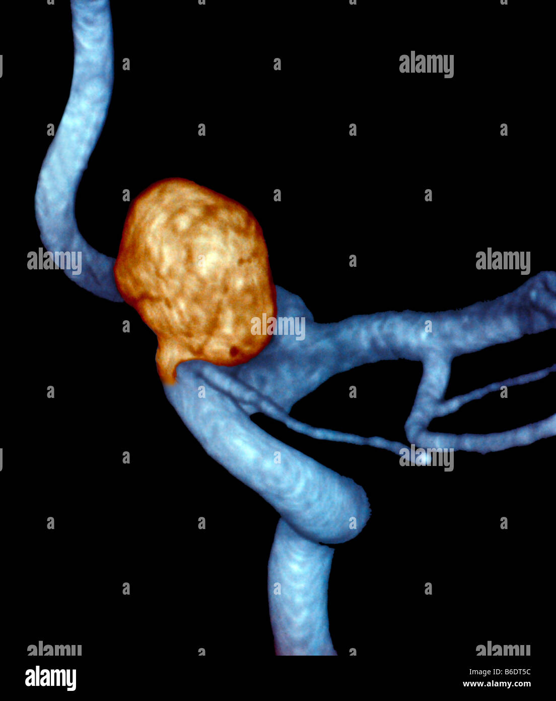 Arteria carotis interna Fotos und Bildmaterial in hoher Auflösung Alamy