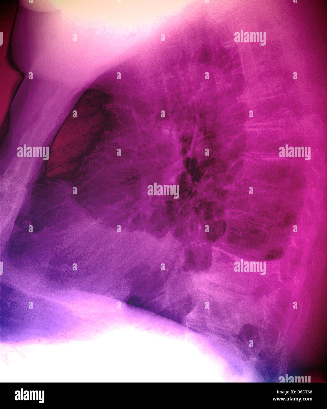 Pleuraerguss. Farbige Seite Röntgen der Lunge eines 60 Jahre alten Patienten mit einem Pleuraerguss der linken Lunge. Stockfoto