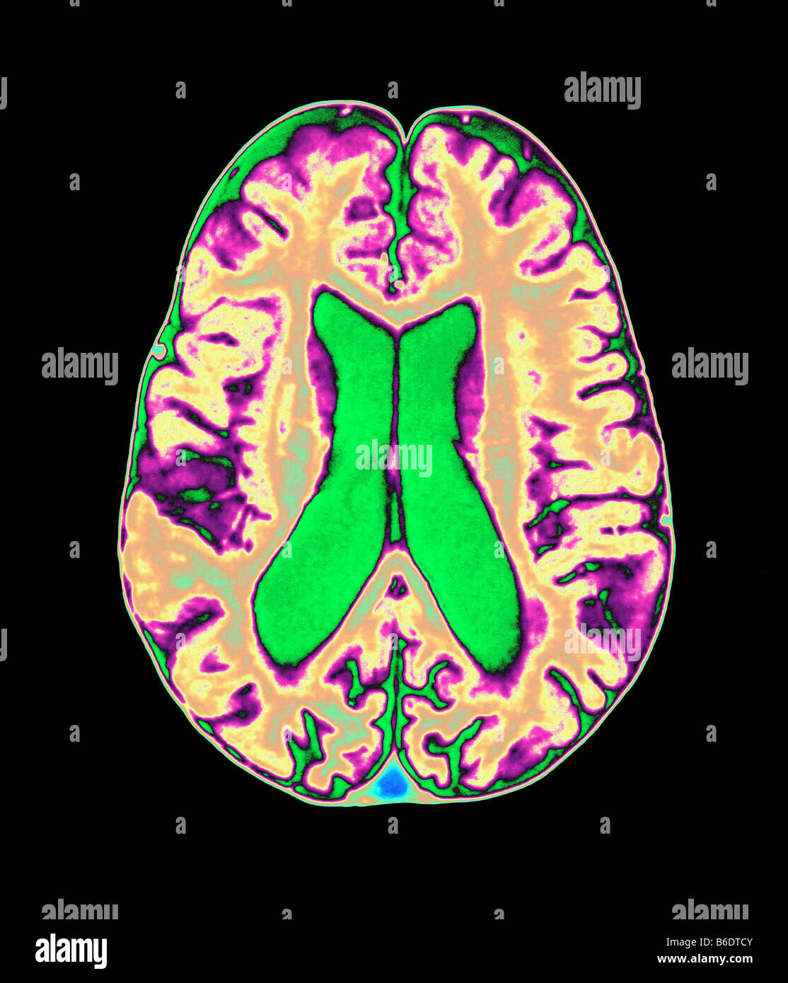 Farbige Magnetresonanz-Bildgebung (MRI) Scan von einem Manandamp, Apos; Sbrain zeigen Schäden durch organophosphatepoisonin Stockfoto