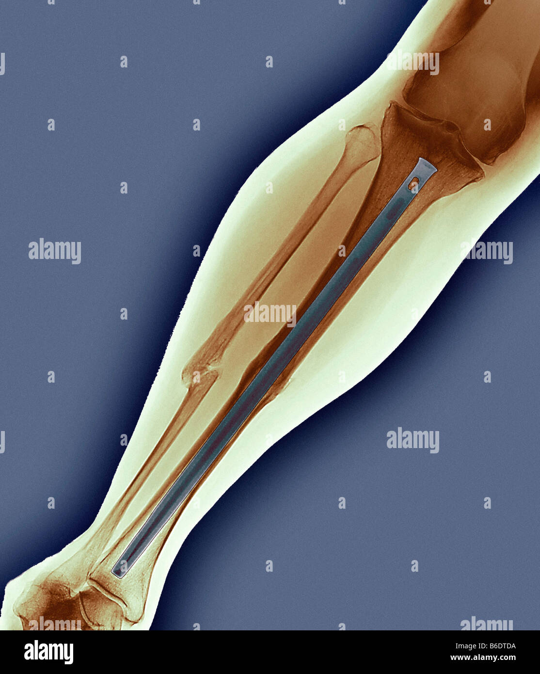 Angeheftete gebrochenes Bein farbig x-ray. Der Patient Stibia (Schienbein) hat chirurgisch immobilisiert. Stockfoto