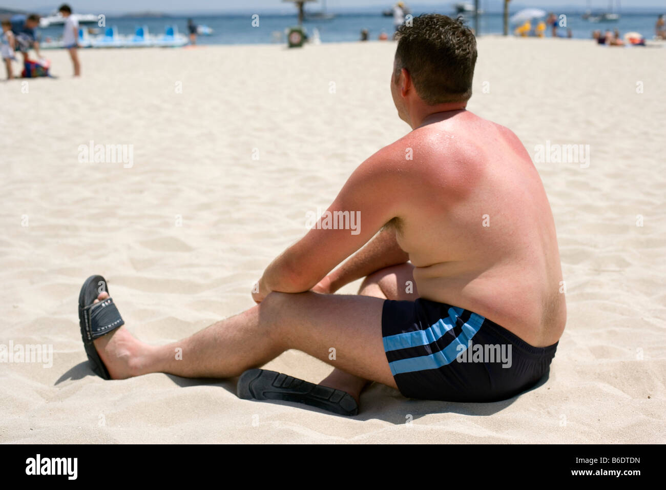 Mann mit sonnenverbrannten Schultern sitzen am Strand. Sonnenbrand wird durch übermäßige Sonneneinstrahlung verursacht. Stockfoto