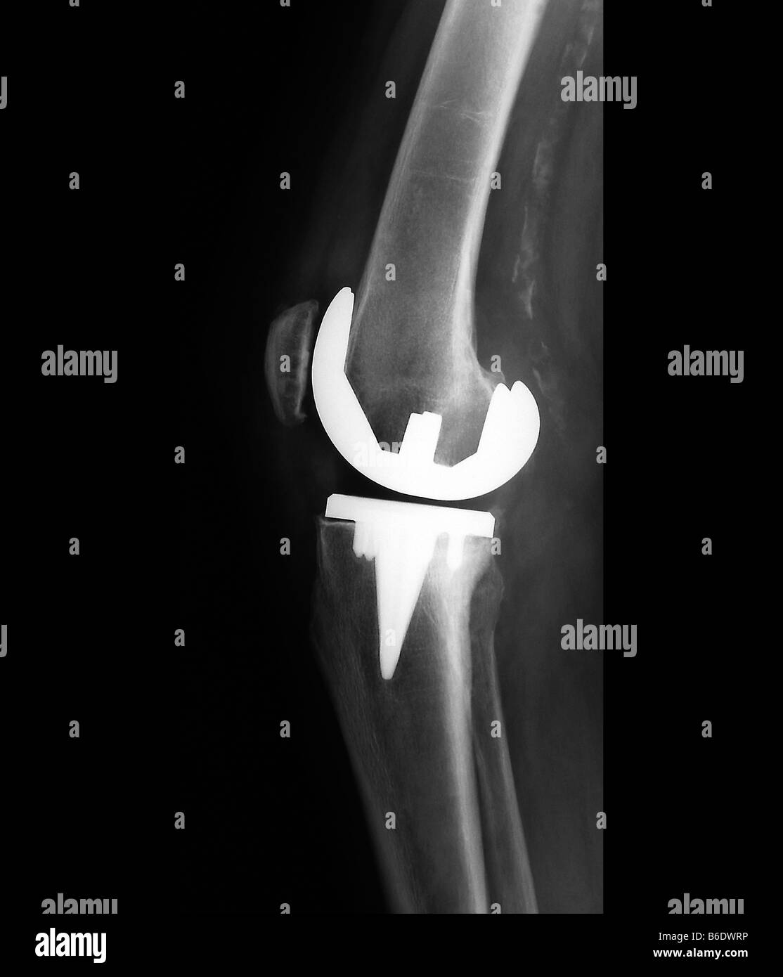 Prothetische Kniegelenk. Profil-Röntgenbild eines Patienten mit einem prothetischen Knie (weiß). Stockfoto