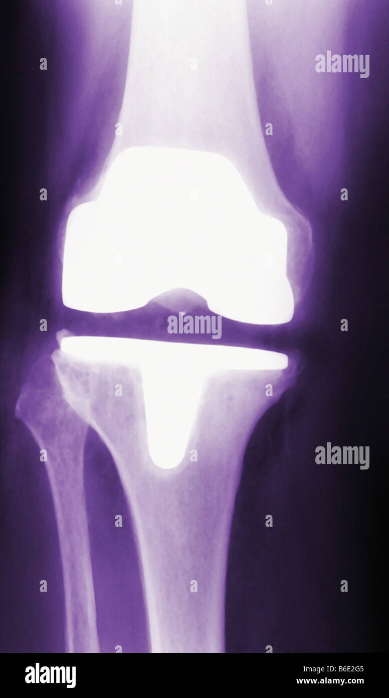 Prothetische Knie. Frontale Röntgenaufnahme eines künstlichen Kniegelenks (weiß) gefärbt. Die prothetischen Kneeis ein Scharniergelenk. Stockfoto