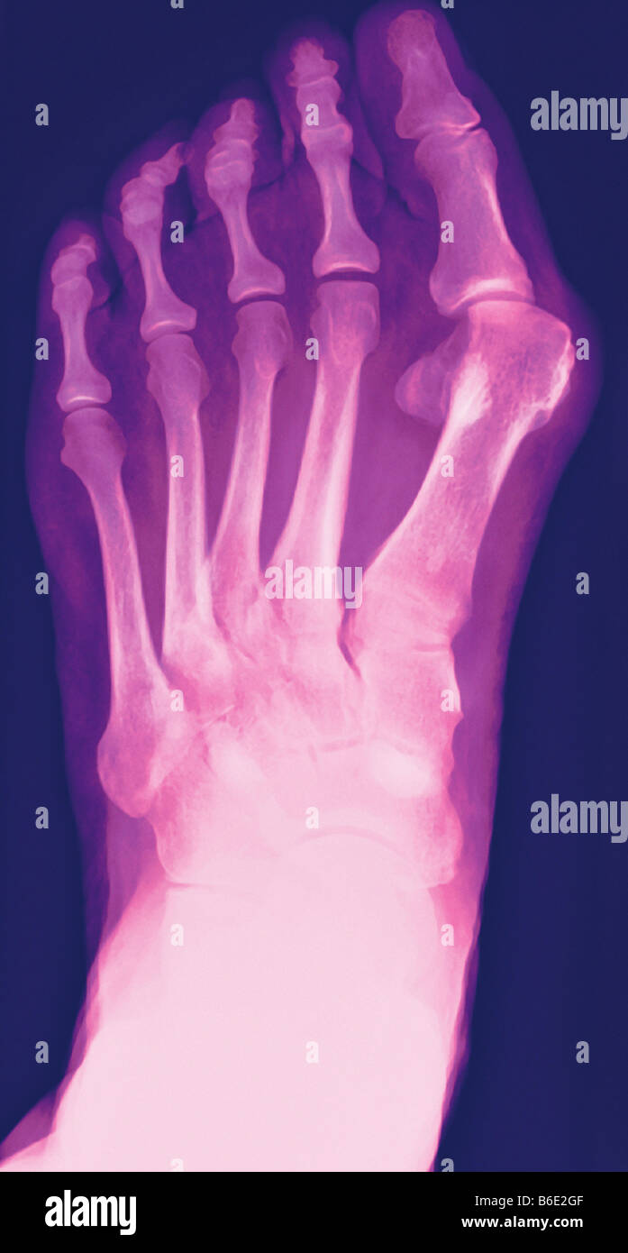 Hallux valgus. Farbig x-ray ein Ballen (Hallux valgus, oben rechts), die Schwellung des Gelenks. Stockfoto