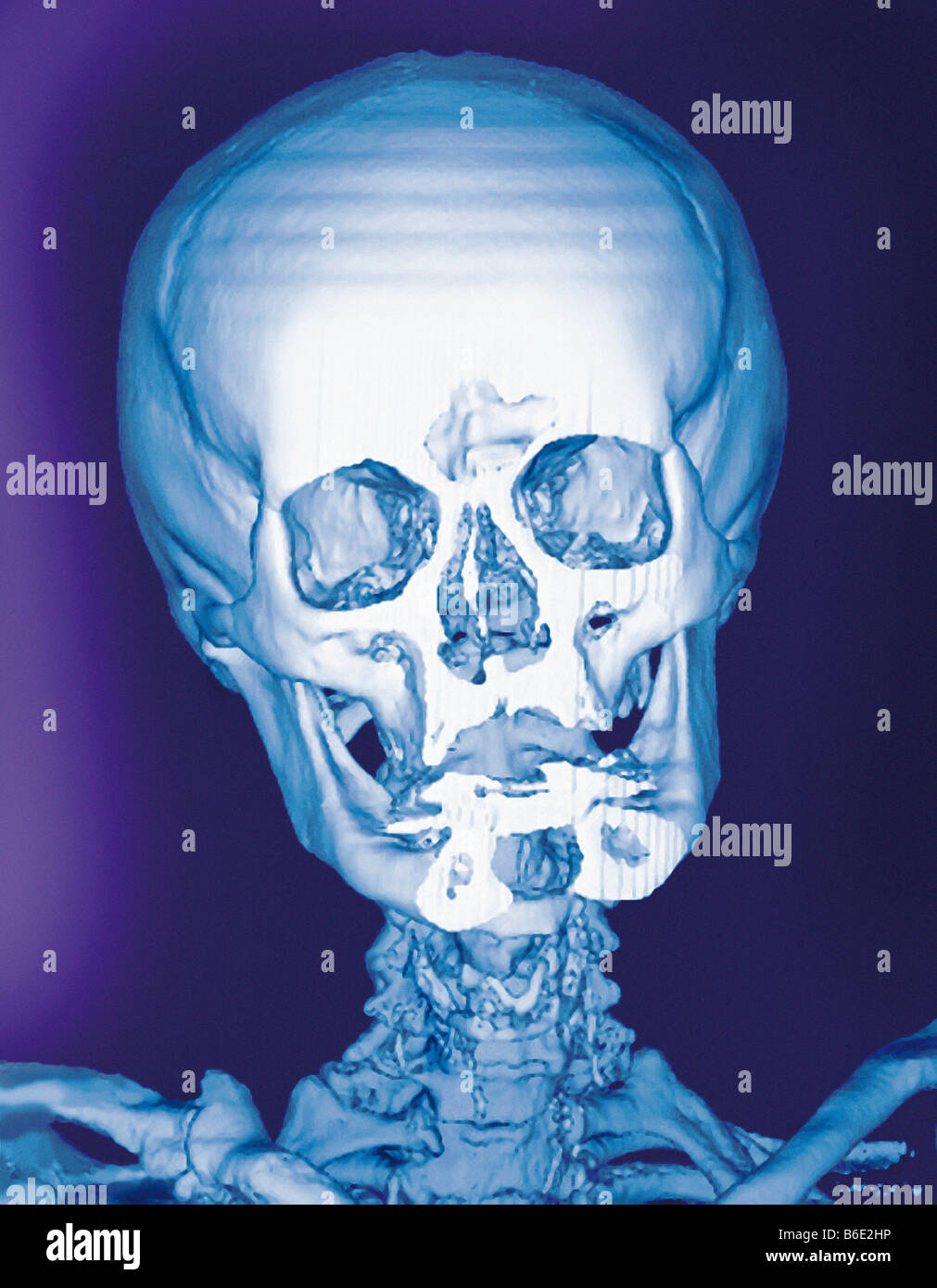 Normale Schädel farbig frontalen 3D Computertomographie (CT) Scan. Stockfoto