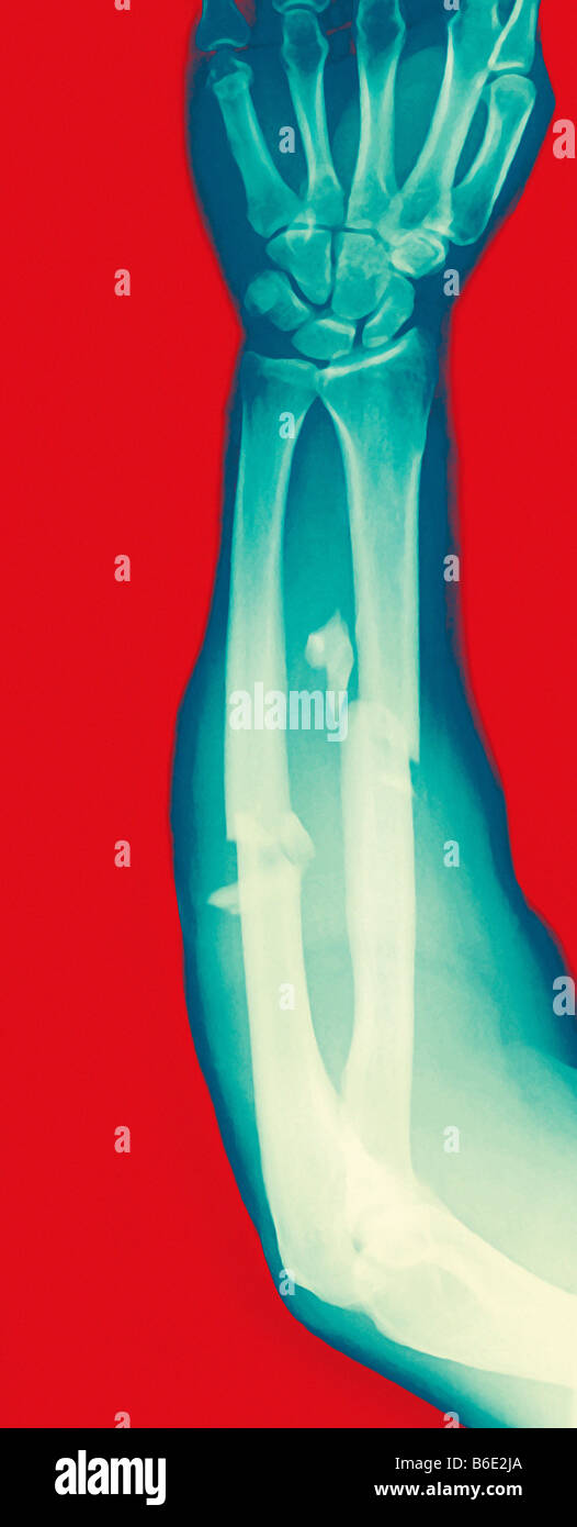 Gebrochenen Arm, farbig x-ray. Die Hand ist oben mit dem Ellbogen im unteren Zentrum. Stockfoto