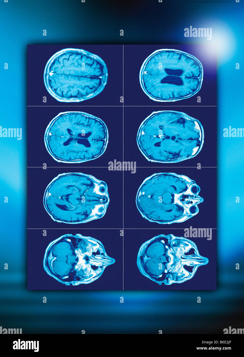 Normale Gehirn. Farbige axiale (Querschnitt) Computertomographie (CT) Scans von einem gesunden Humanhead. Stockfoto