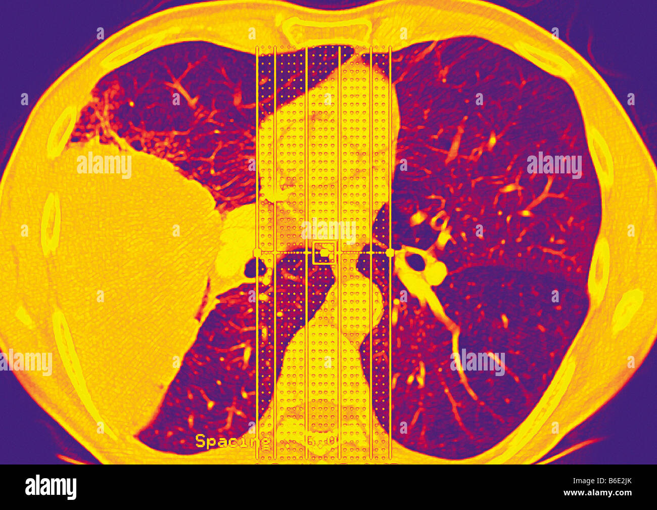 Lungenkrebs. Farbige axiale berechnet Computertomographie (CT)-Scan der eine Brust zeigt einen großen bösartigen Tumor. Stockfoto