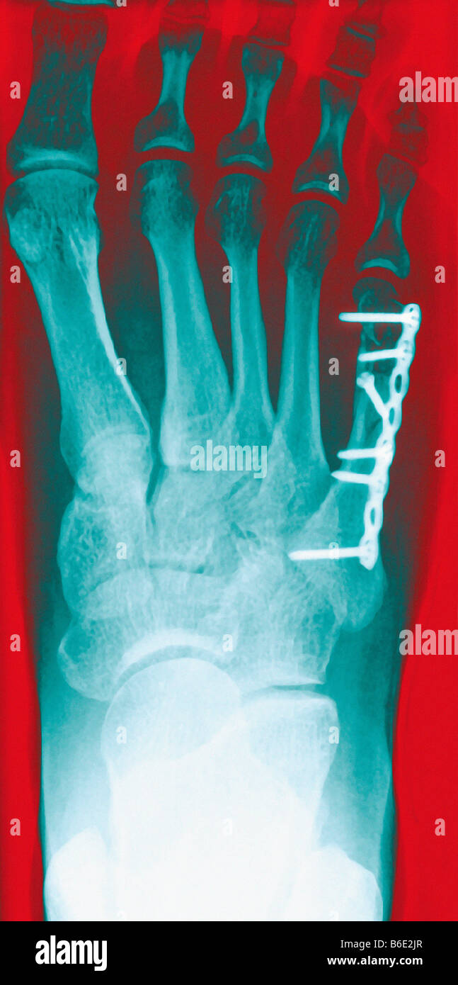 Farbige Röntgenbilder des rechten Fußes, mit einer Metallplatte und Schrauben in den Fußknochen unter dem kleinen Zeh. Stockfoto