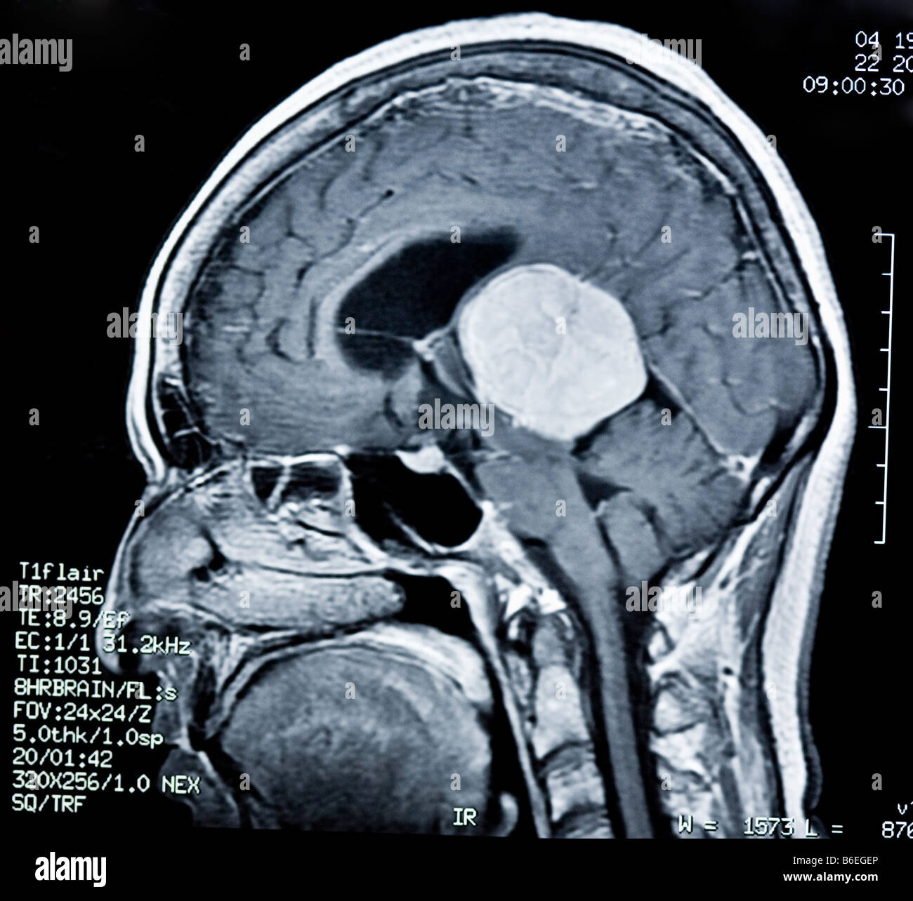 Sagittale MRT des Gehirns mit großem Hirntumor/Krebs Stockfoto