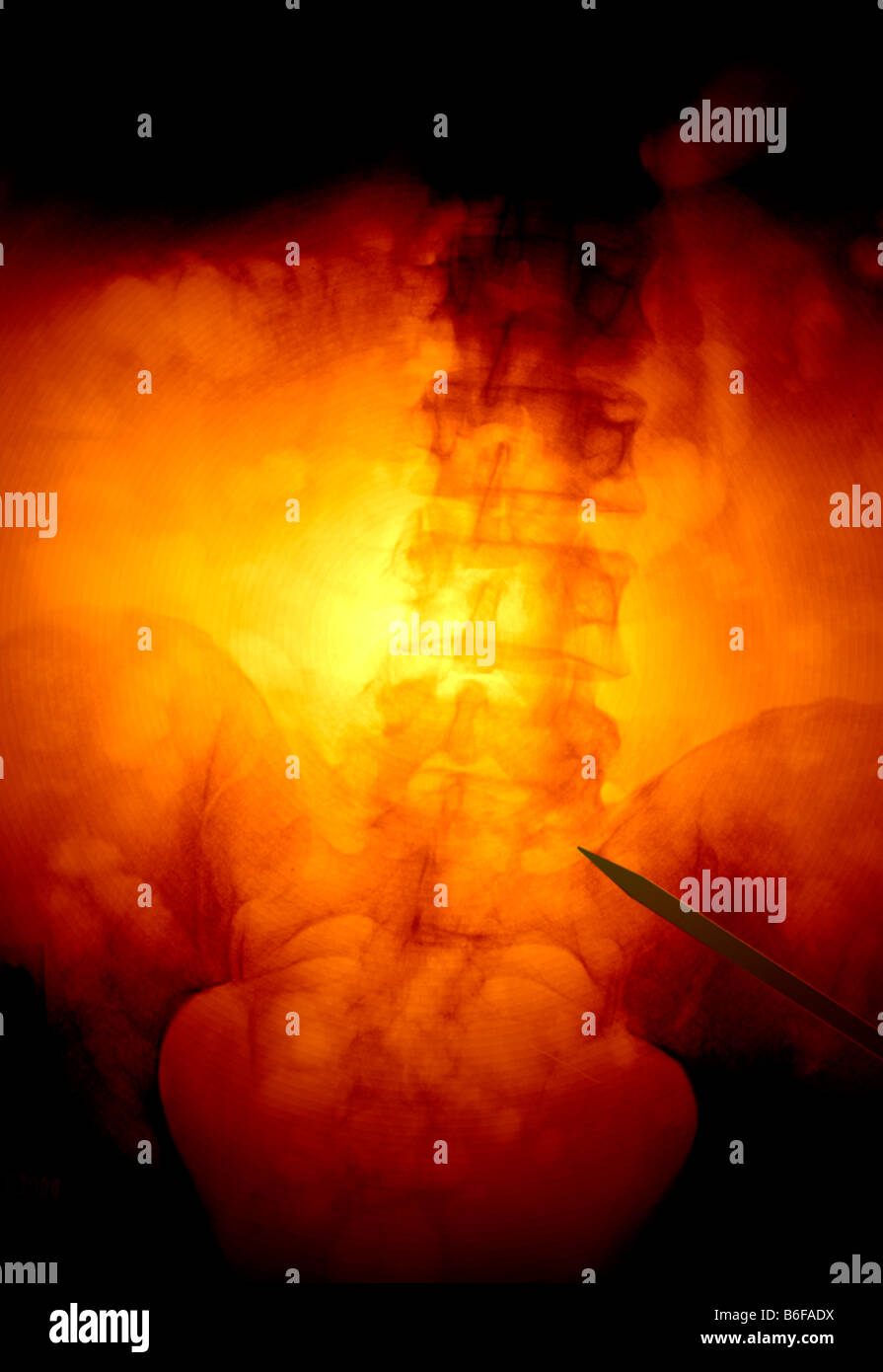 farbcodierte Röntgen des erkrankten menschlichen Wirbelsäule Stockfoto