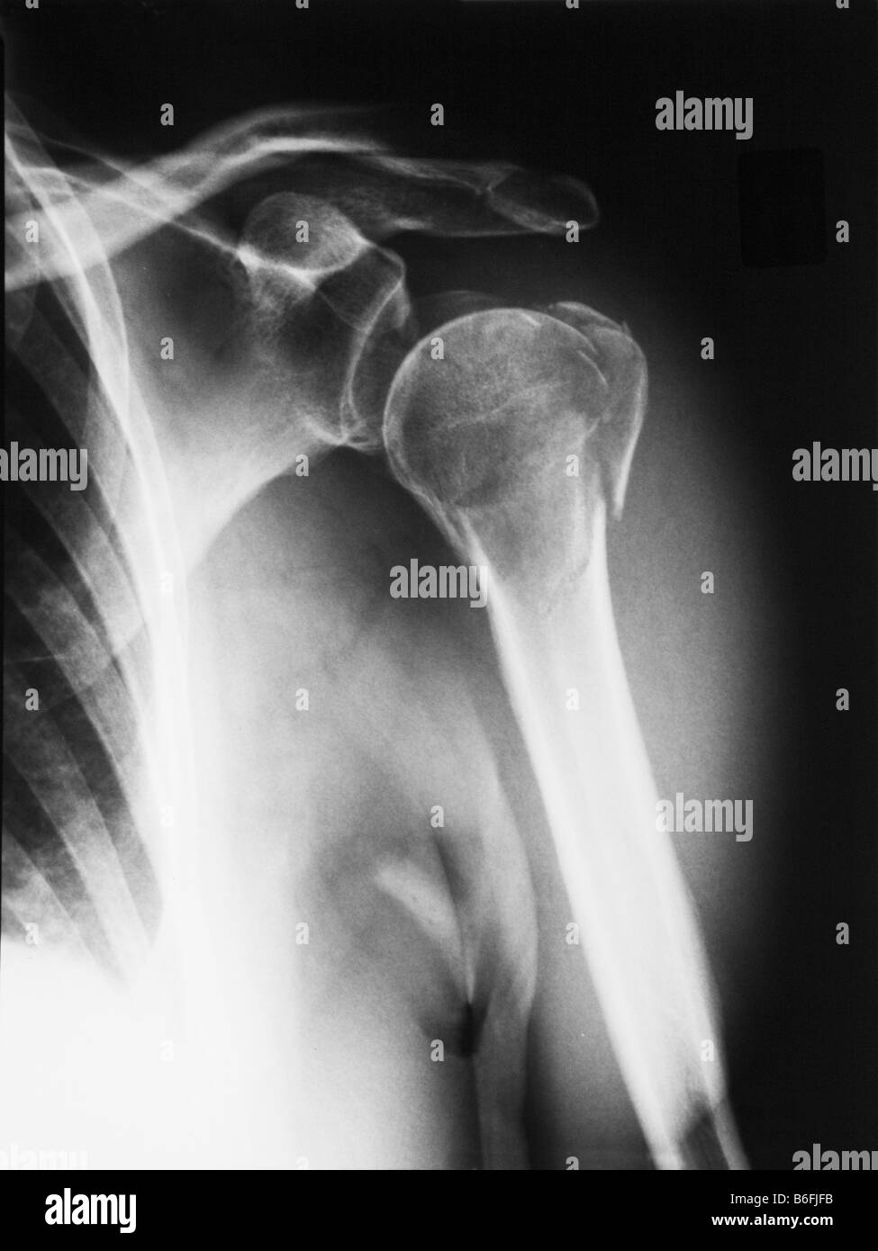 Röntgenbild eines gebrochenen Oberarm präoperativ 50 jährige Frau Stockfoto
