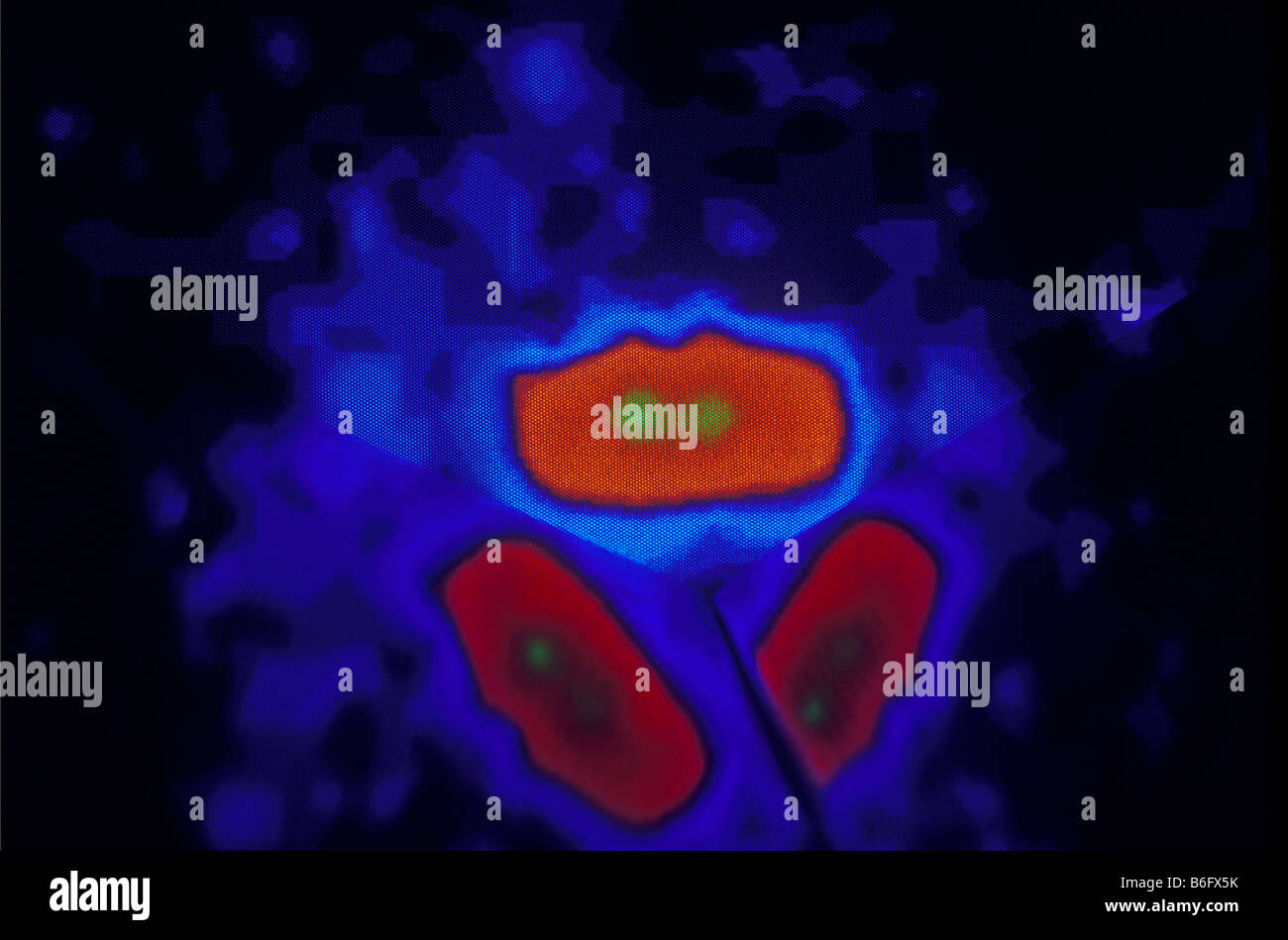 diagnostische Bildgebung Becken-Tumor Scannen MRT Wissenschaft medicene Stockfoto