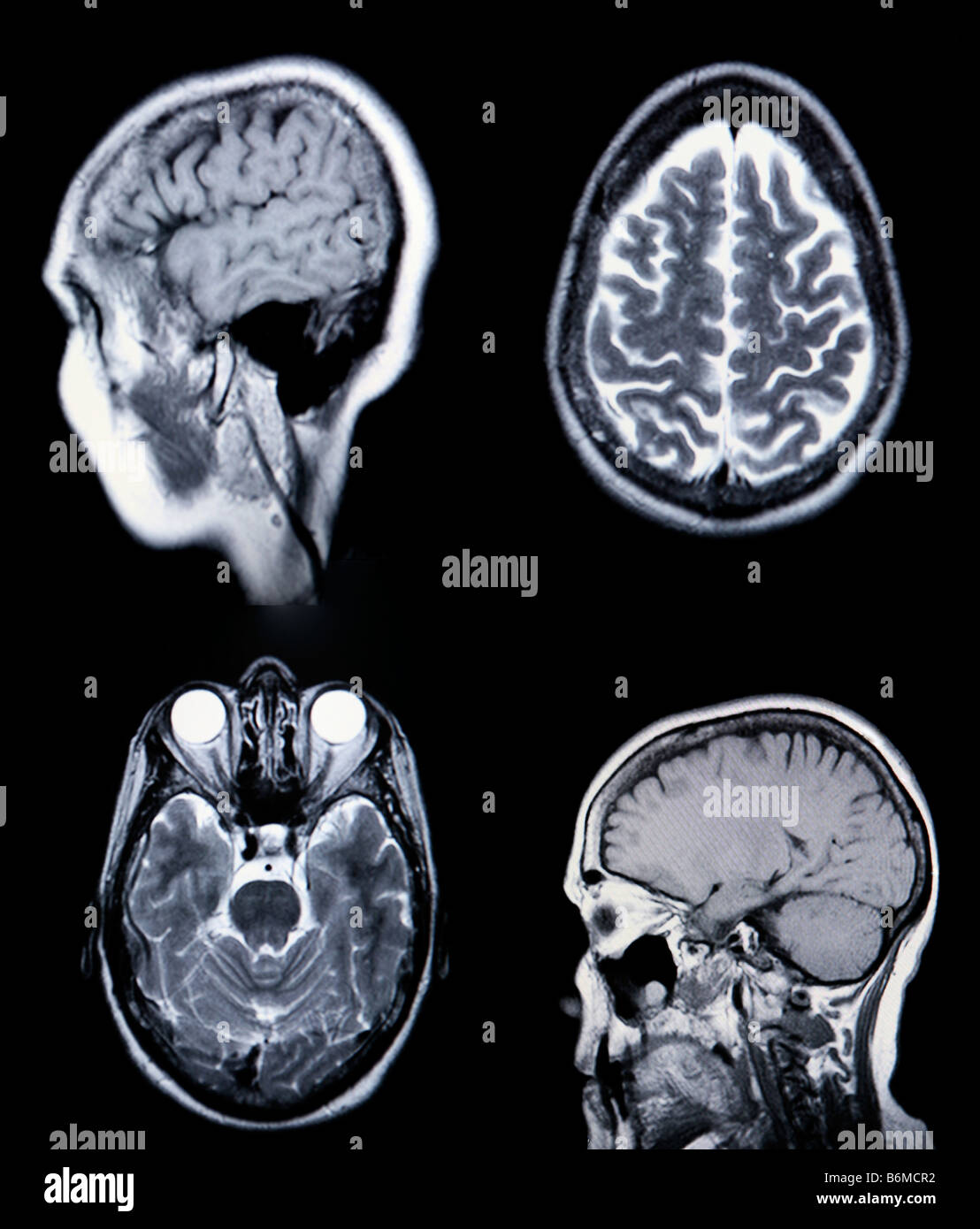 Hohe Auflösung MRI MRA Magnetic Resonance Angiogramm des Gefäßsystems Hirnarterien CRT Monitor Korn sichtbar Stockfoto