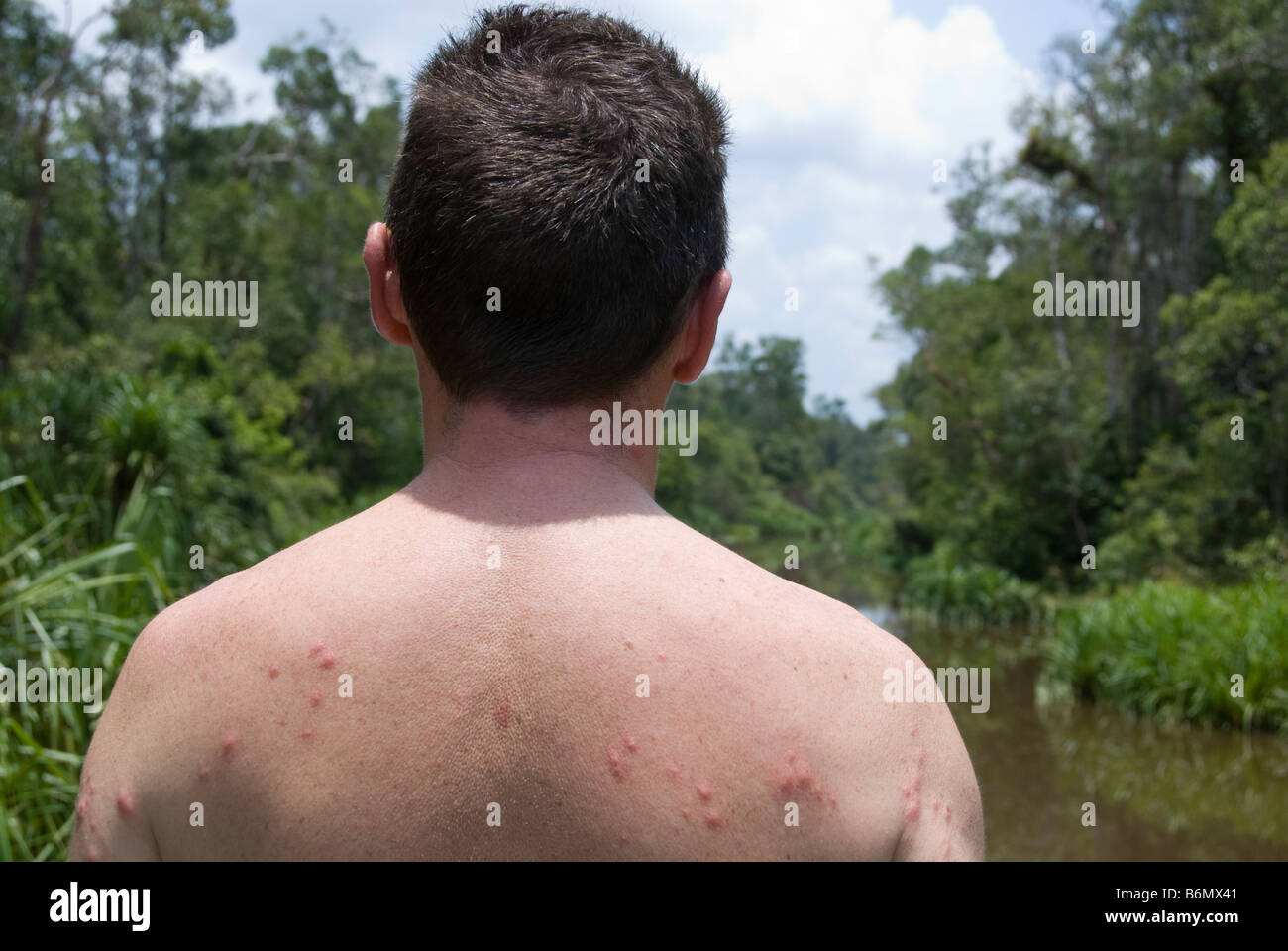 Mann mit Moskito beißt auf seinem Rücken in der Nähe eines Flusses in Borneo Stockfoto