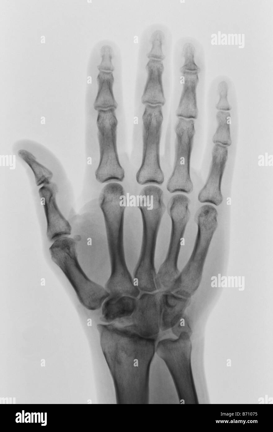 Rontgenbild Einer Hand 1