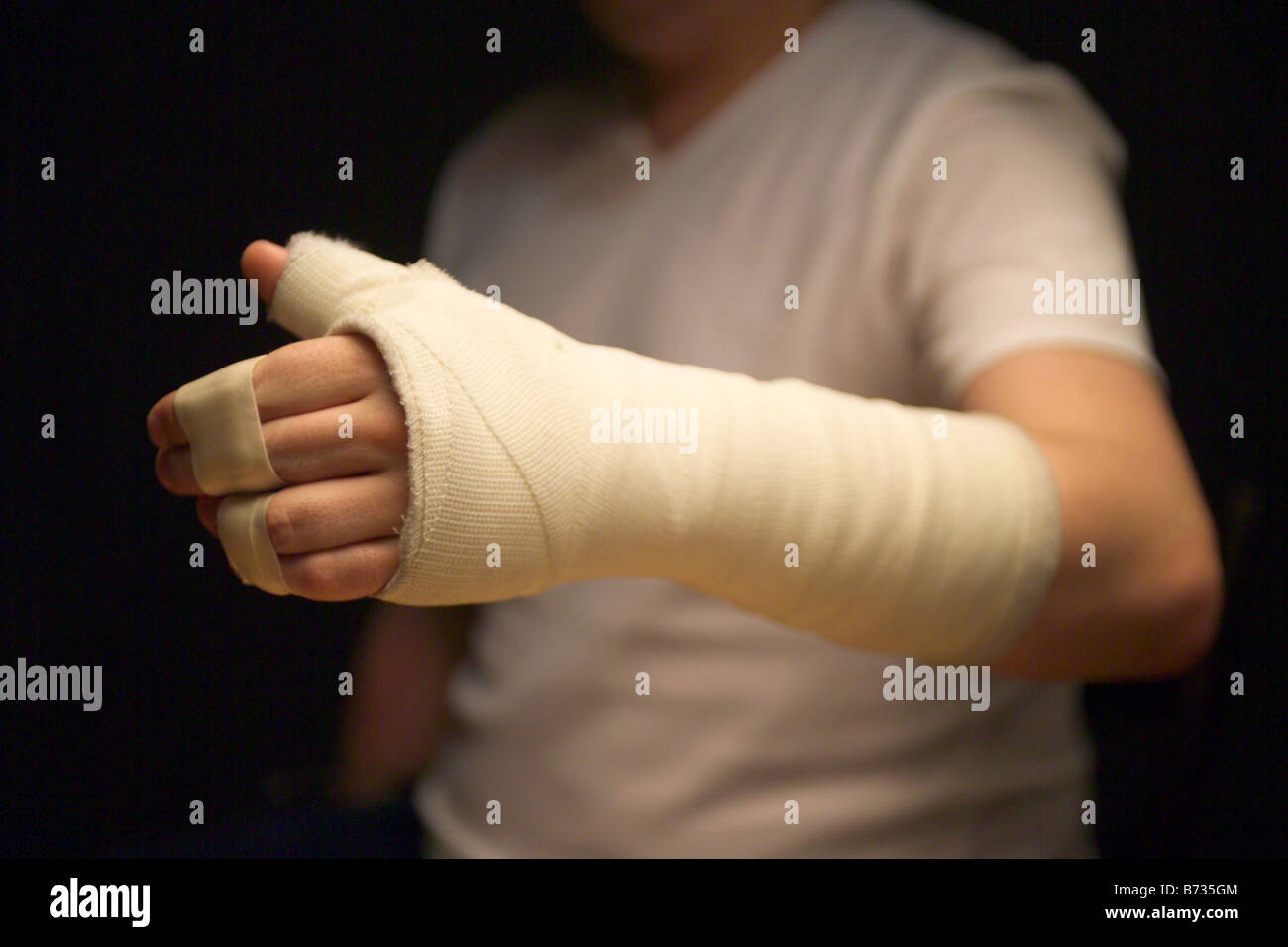 einen gebrochenen Arm in Gips Stockfoto