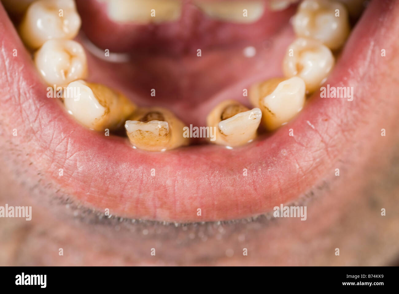 Nahaufnahme von schlechten Zähnen Stockfotografie Alamy