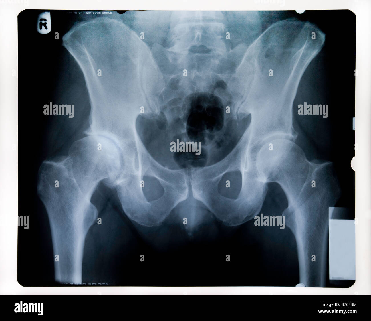 RÖNTGENAUFNAHME DES MÄNNLICHEN BECKENS MIT ABGENUTZTE HÜFTGELENK Stockfoto