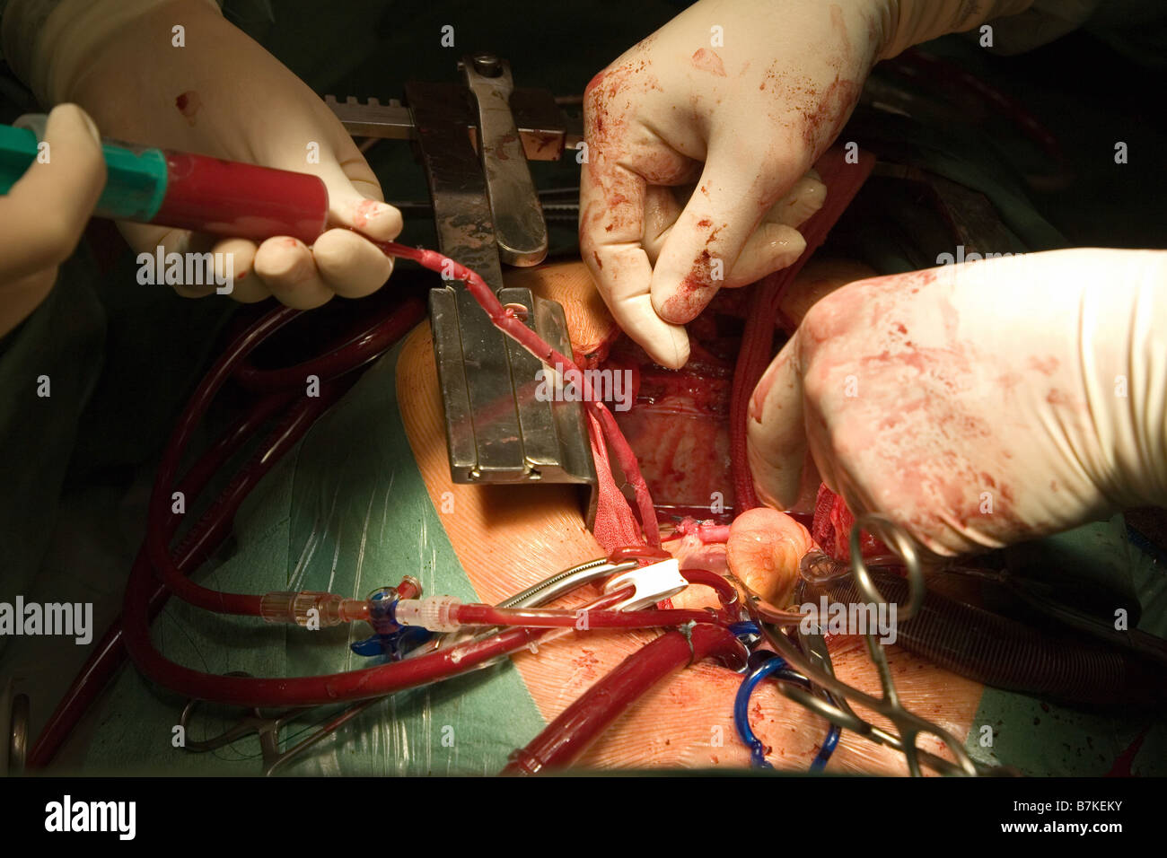 Herz-Chirurgie, CABG, Aorto-koronarer Bypass Stockfoto