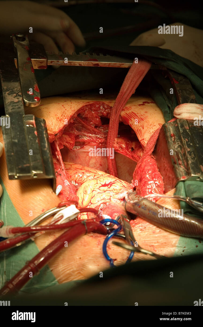 Herz-Chirurgie, CABG, Aorto-koronarer Bypass Stockfoto