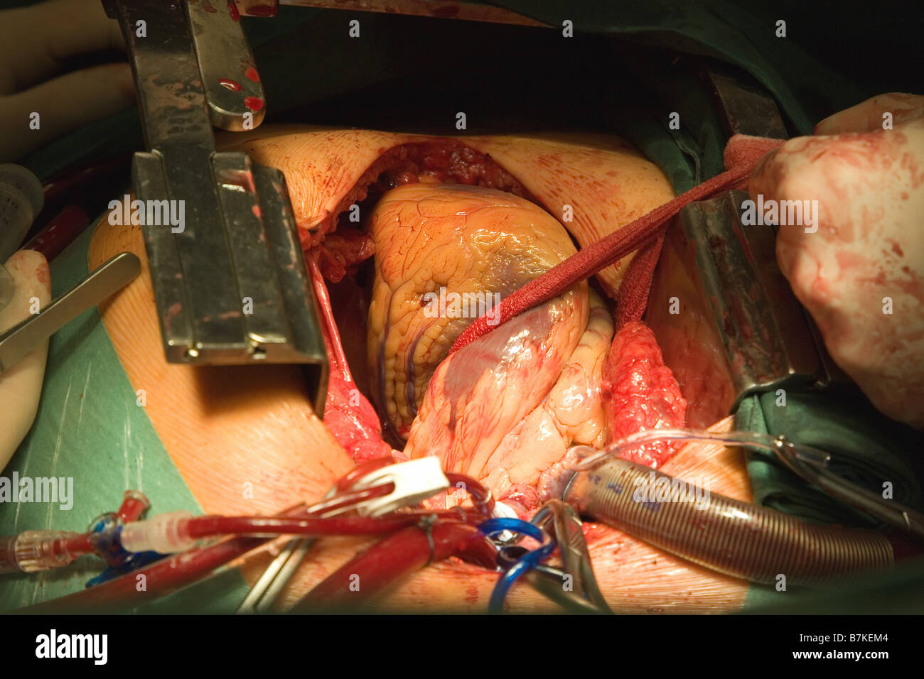 Herz-Chirurgie, CABG, Aorto-koronarer Bypass Stockfoto