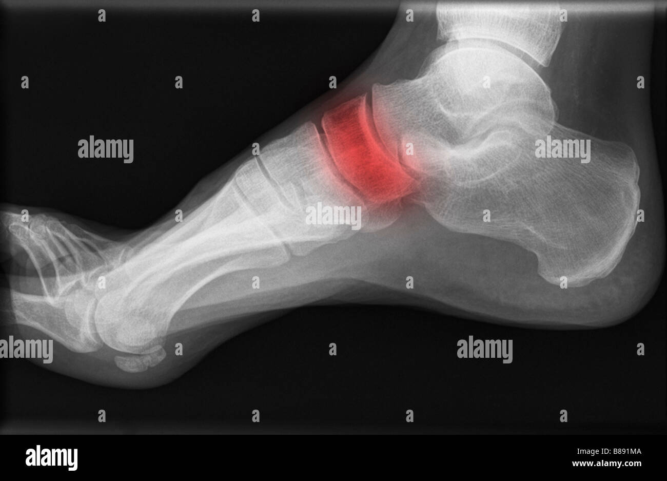 XRAY des menschlichen Fußes illustriert Probleme mit einem Knochen Stockfoto