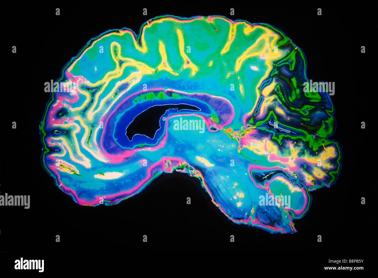 Künstlich gefärbten MRT-Untersuchung des menschlichen Gehirns Stockfoto