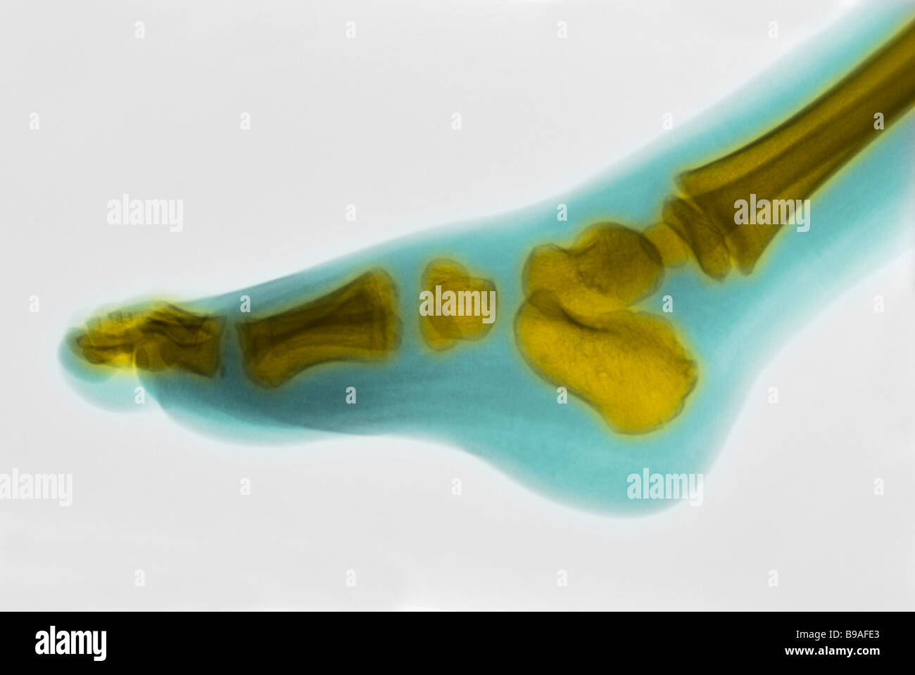 normales Röntgenbild eines 4 Jahre alten männlichen Fußes Stockfoto