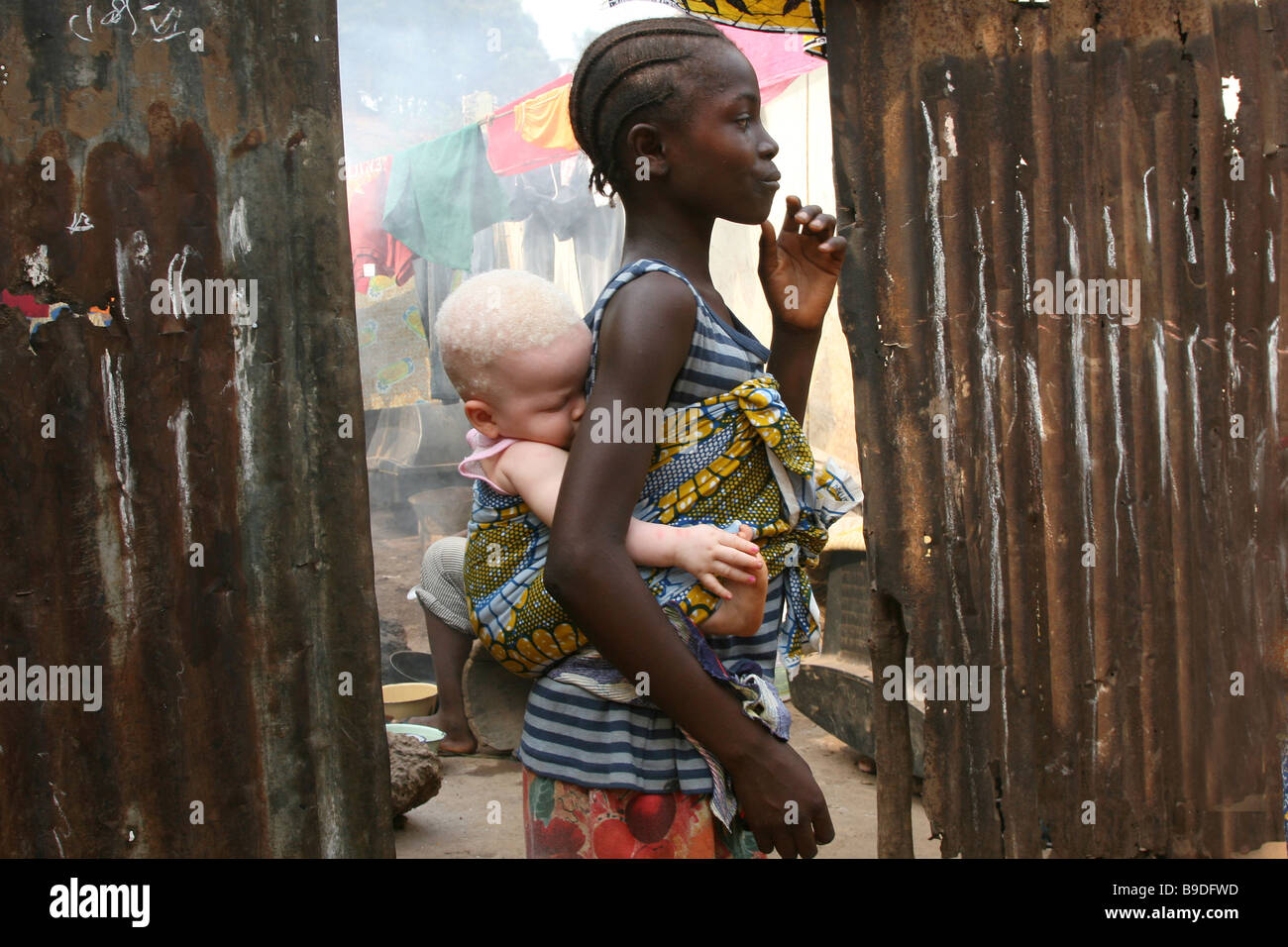 junge schlafende Albino-Mädchen in Sierra Leone, Afrika, auf der Rückseite ihrer Schwester Stockfoto