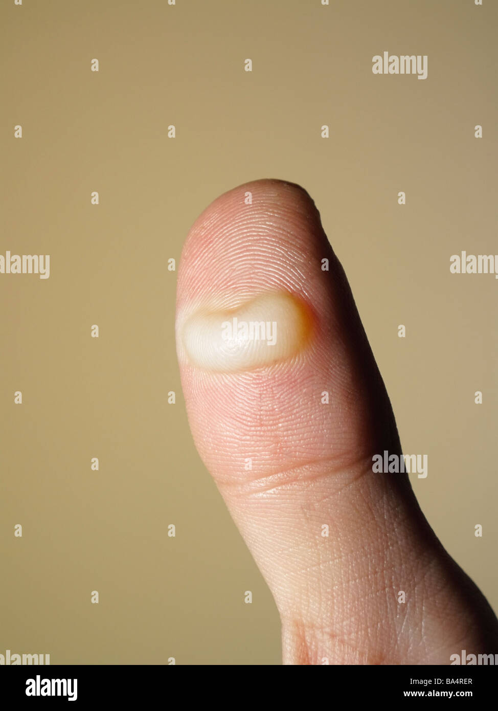 Blase am Daumen aus brennen Stockfotografie - Alamy