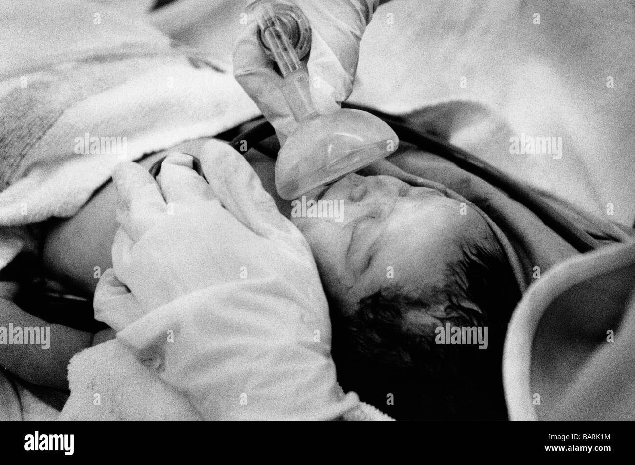 Baby-wiederbelebt mit Sauerstoff nach einer schwierigen Geburt am Homeron Hospital in London Stockfoto