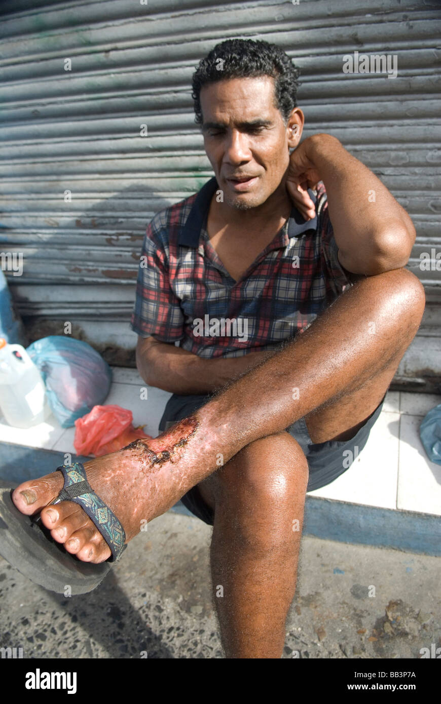 Dieser Mann in Panama-Stadt war vor 7 Jahren von einem Stachelrochen gestochen. Aufgrund der Kosten für medizinische Hilfe ist die Wunde noch superating Stockfoto